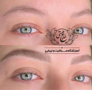 میکروبلیدینگ به روش فیبروز